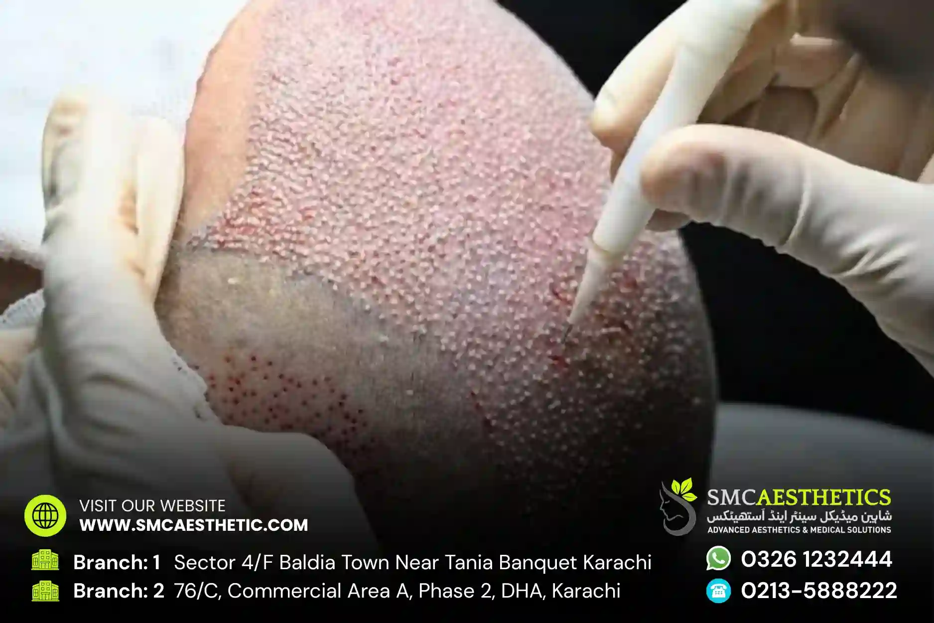 DHI Hair Transplant Hairline Restoration Results - SMC Aesthetics Karachi